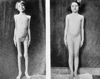 An early patient, before and after insulin